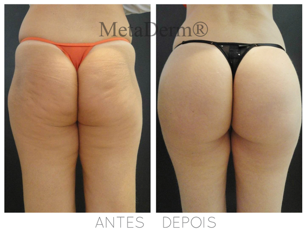 Bioplasta de Glúteos Antes e Depois - Preenchimento Corporal